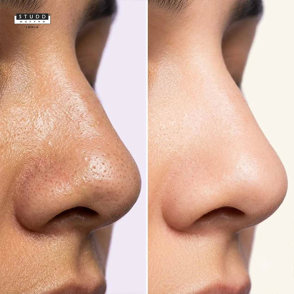 Nose Scrub